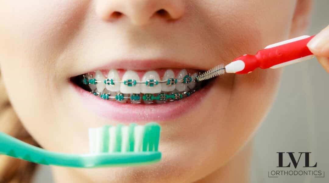 pediatric orthodontist Dallas - child braces